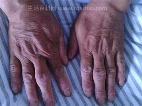 手指类风湿性关节炎怎么办,请问是何病症，如何治