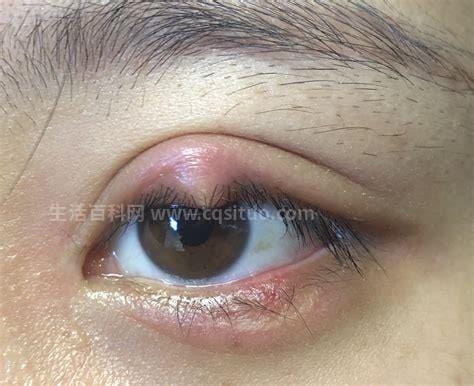 眼睑发炎可以自愈吗