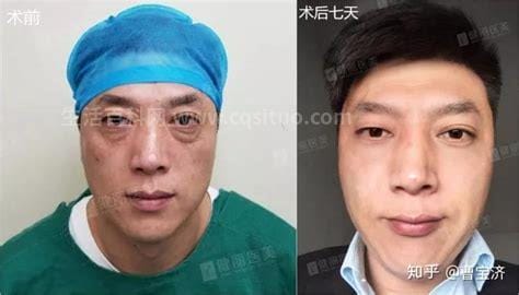 男士如何去除眼袋