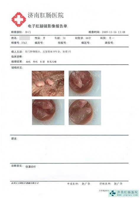 痔疮是长什么样