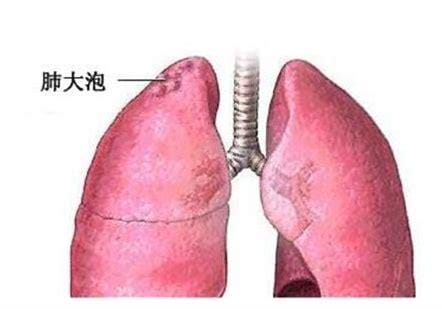 肺气泡可以治愈吗