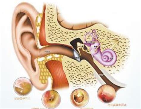 耳膜炎是什么症状