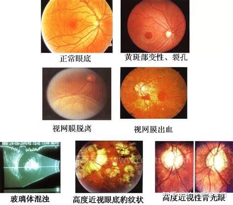 眼底病有哪些