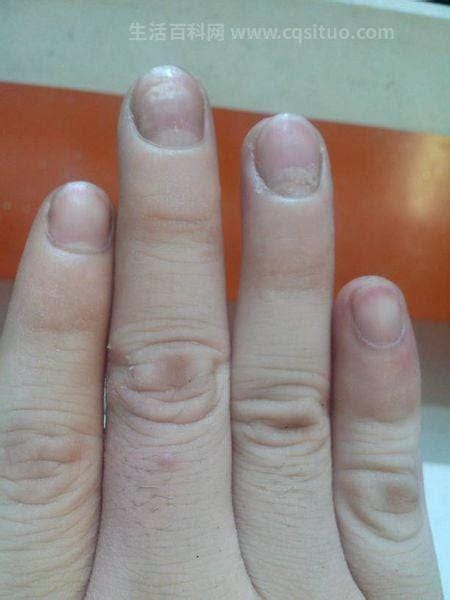 无名指指甲凹陷是什么原因