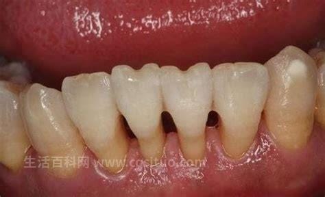 牙龈萎缩恢复的方法