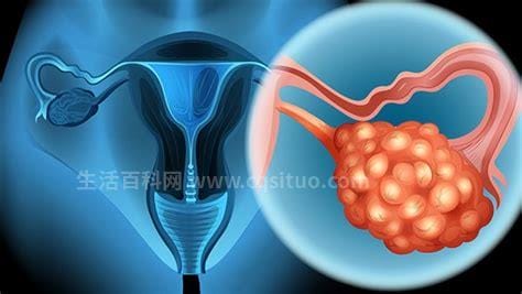 什么叫卵巢囊肿是什么