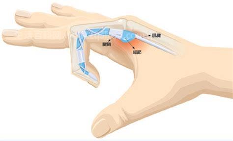 手指腱鞘炎症状有哪些
