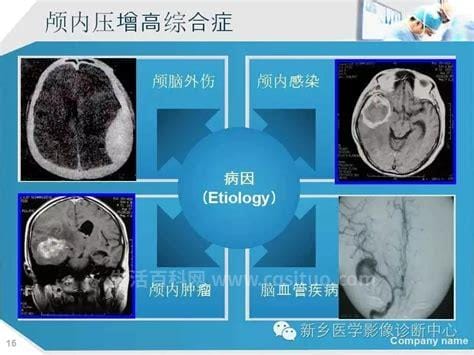 颅内压增高的临床表现