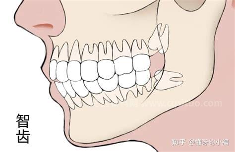 埋伏牙一定要拔吗