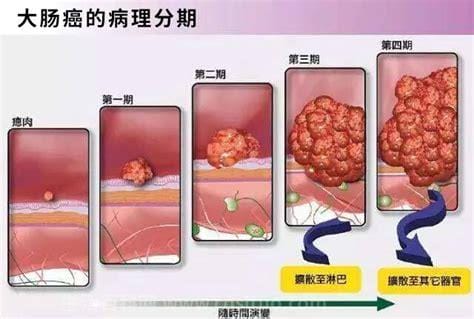 痔疮癌的症状