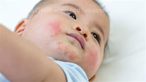 宝宝荨麻疹怎么治疗