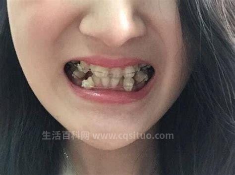 14岁牙齿矫正的利弊是什么