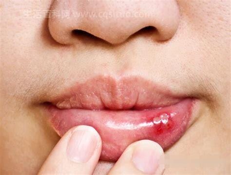 口舌生疮是什么原因
