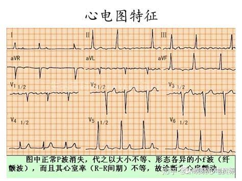 房颤的听诊特点