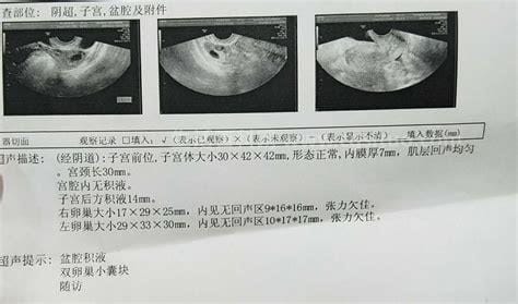 卵泡囊肿怎么回事