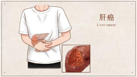晚期肝癌夜里睡觉三大预兆，警惕口干舌燥/右上腹刺疼是肝脏不好了