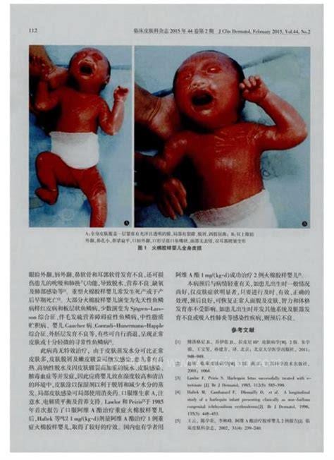 火棉胶婴儿的病因是什么