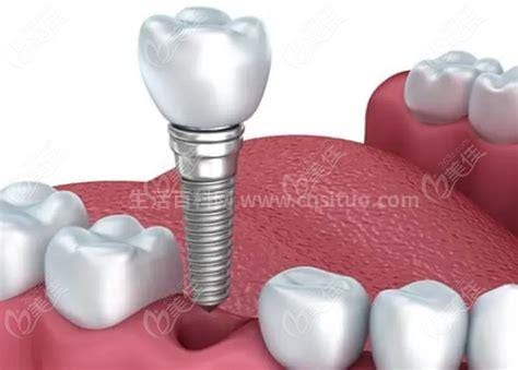 种植牙多少钱一颗2023价目表，单珠诊