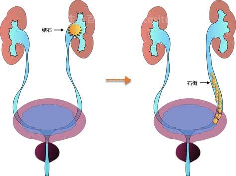 尿结石是怎么形成的是什么原因