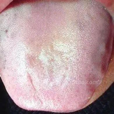 舌头开裂是什么病