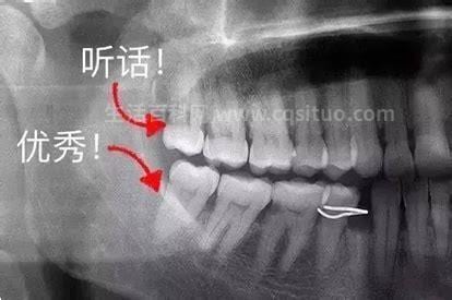 智牙一定要拔掉吗