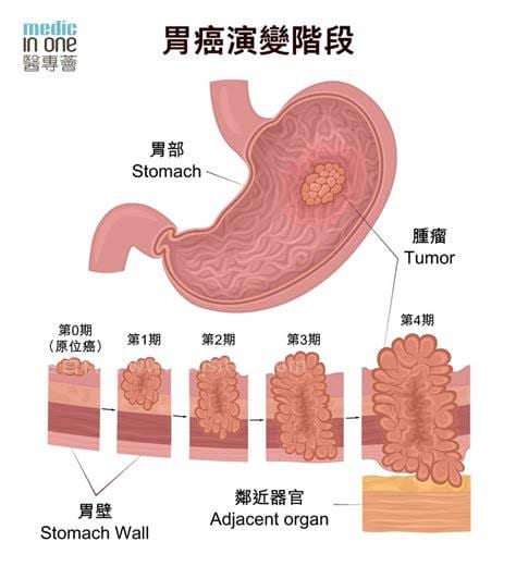 胃癌的症状和前兆