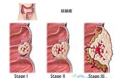 肠道肿瘤的早期症状