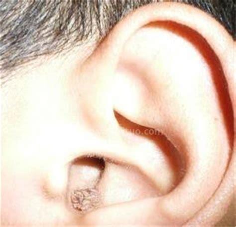 外耳道炎的症状