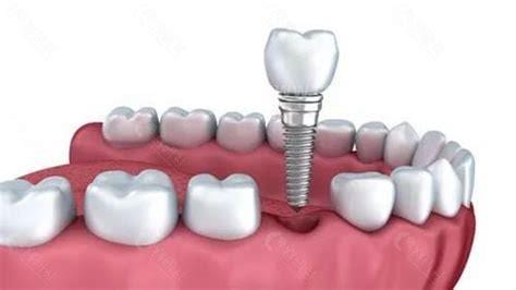 医疗种植牙的危害有哪些