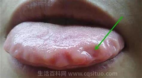 舌根痛是怎么回事