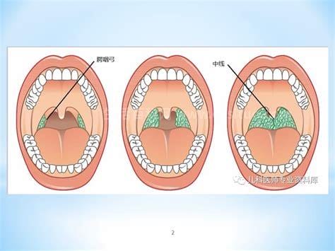 切除扁桃体有哪些利弊