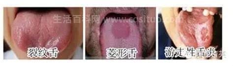 舌炎治疗方法