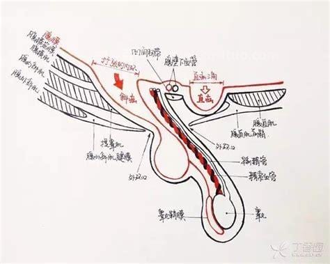 运动性疝气是什么意思