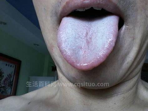 舌头上有白苔是什么原因