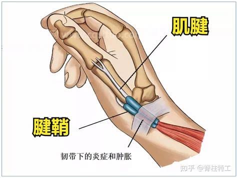 治疗腱鞘炎的办法