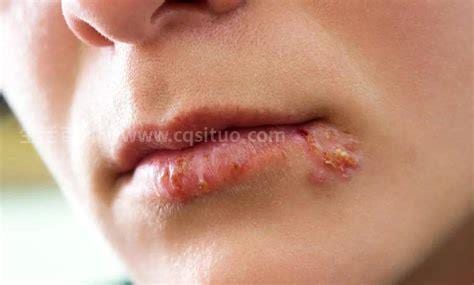 唇疱疹的治疗方法