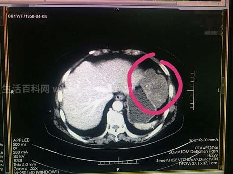 胃间质瘤是什么