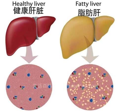 如何减脂肪肝
