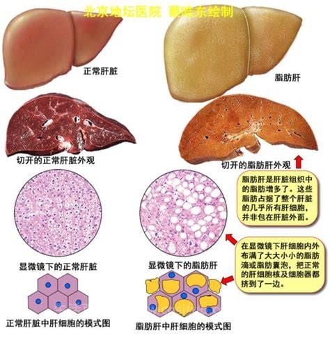 脂肪肝的危害有哪些