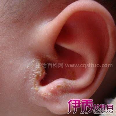 宝宝中耳炎症状