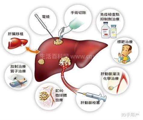 肝癌晚期症状有哪些