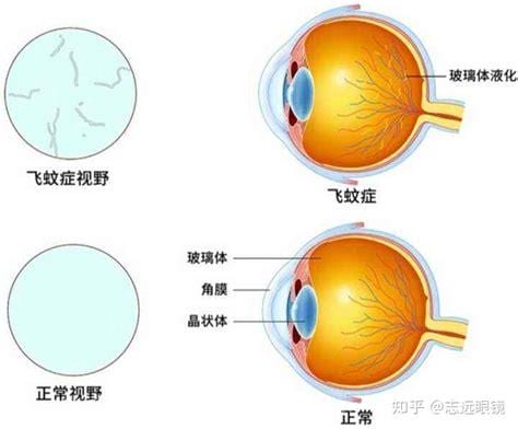 飞蚊症是怎么回事