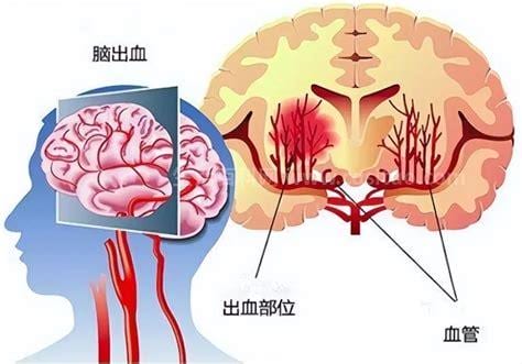 脑溢血的后遗症是什么