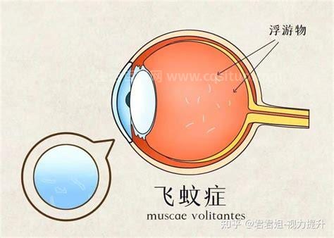 眼前飞蚊症怎么治疗