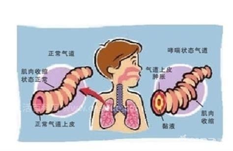 变异性哮喘的症状有哪些