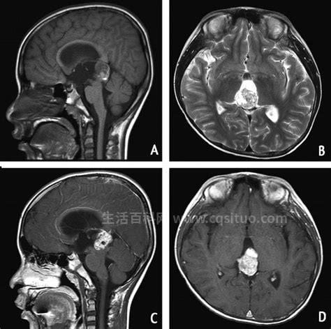 松果体瘤是什么病
