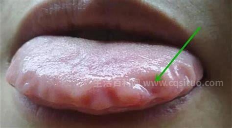 舌头痛是什么原因