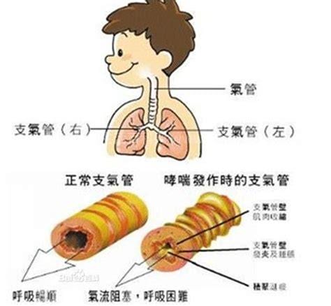 过敏性支气管炎怎么造成的