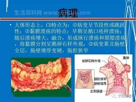 克罗恩病是什么病