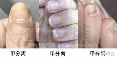 灰指甲可以通过哪些方式传染